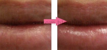 lip treatment