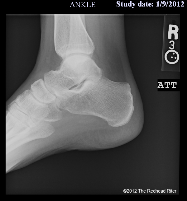 X-ray of my foot and Plantar Fascia Ligament